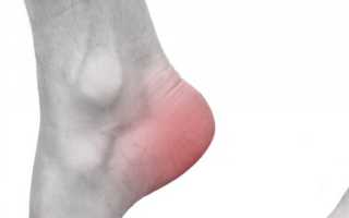 Симптомы и методы лечения подагры на ноге