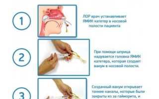 Синус-катетер ЯМИК: как проводится процедура безоперационного лечения гайморита