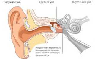 Кондуктивная потеря слуха: какое лечение назначают при тугоухости 1 степени