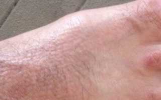 Каковы причины появлениях сросшихся пальцев на ногах?