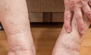 Причины возникновения и лечение отека ног у пожилых людей