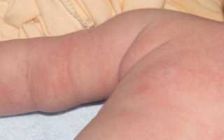 Сыпь на грудной клетке у ребенка