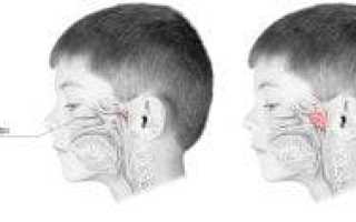 Отек слизистой носа: симптомы и лечение при аллергическом рините
