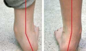 Причины и лечение вальгусной деформации стопы