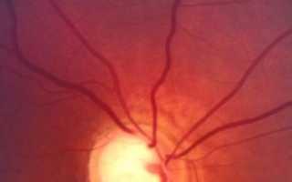Проявление симптомов и лечение воспаления глазного нерва