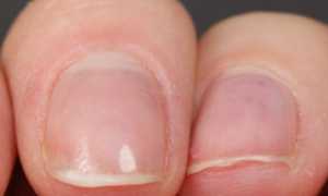 Возможные причины деформации ногтей на руках