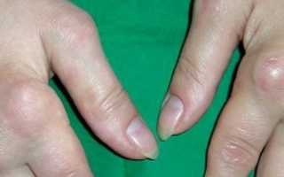 Как лечить артроз пальцев рук, а так же его симптомы и профилактика