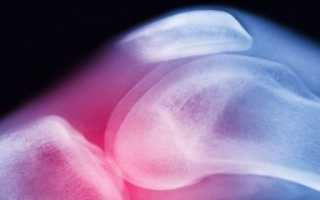 Особенности лечения болей в колене народными средствами