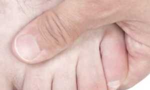 Перелом мизинца на ноге: причины, симптомы и лечение