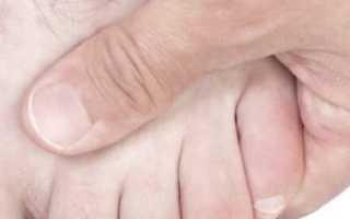 Перелом мизинца на ноге: причины, симптомы и лечение