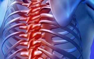 Симптомы и лечение защемления нерва в грудном отделе позвоночника