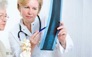 Причины, симптомы и методы лечения остеопороза