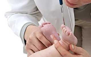 Дисплазия тазобедренного сустава новорождённого: понятие, признаки, лечение