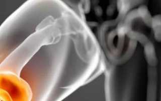 Основные причины и лечение препателлярного бурсита коленного сустава