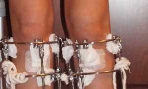 Исправление кривизны ног с помощью хирургических операций и физических упражнений