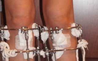 Исправление кривизны ног с помощью хирургических операций и физических упражнений