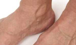 Артрит стопы: симптомы, лечение воспаления в домашних условиях