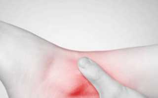 Симптомы и лечение растяжения связок голеностопа