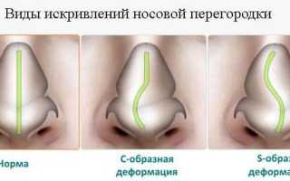 Эндоскопическая септопластика носовой перегородки: как проходит операция