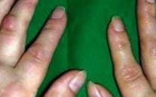 Что делать, если появилась шишка на пальце: причины появления и тактика лечения