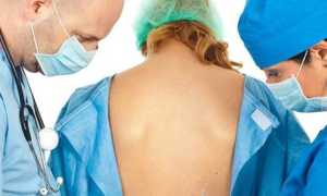 Что делать, если болит спина после эпидуральной анестезии?