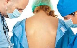 Что делать, если болит спина после эпидуральной анестезии?