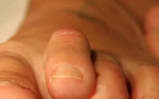 Основные симптомы и способы лечения вывиха пальца на ноге