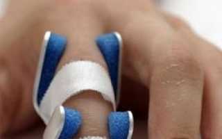 Виды, симптомы и лечение перелома фаланги пальца на руке