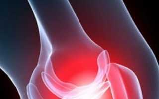 Что такое гемартроз коленного сустава и как лечить это состояние