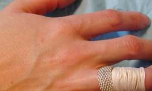 Как самостоятельно снять кольцо с опухшего пальца