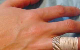 Как самостоятельно снять кольцо с опухшего пальца