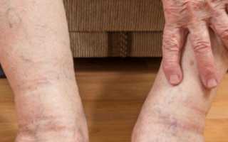 Причины и лечение возрастных судорог в ногах ночью