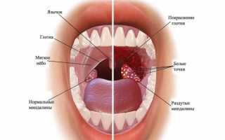 Грибок в горле –  как лечить: 19 эффективных препаратов для лечения горла