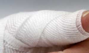 Ушиб пальца на руке: рекомендации по лечению в домашних условиях