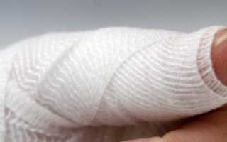 Ушиб пальца на руке: рекомендации по лечению в домашних условиях