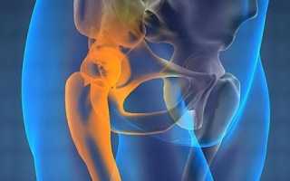 Характерные симптомы и лечение при защемлении нерва в тазобедренном суставе
